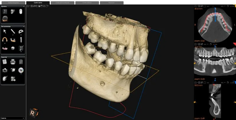 imagen de TAC 3D Completo en ambas arcadas